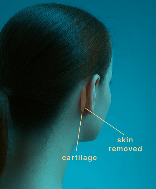 Otoplasty