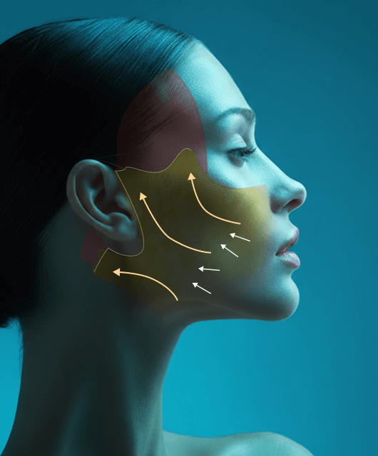 Deep Plane Facelift
