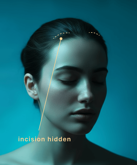 Endoscopic Facelift