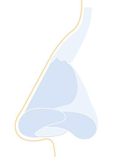 Revision Rhinoplasty