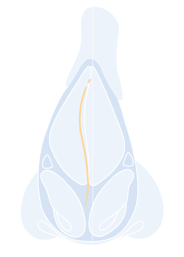 Revision Rhinoplasty