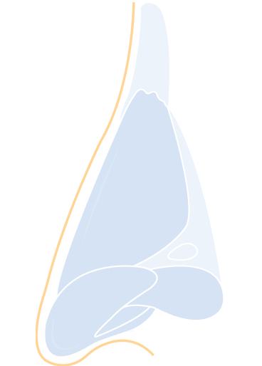 Revision Rhinoplasty