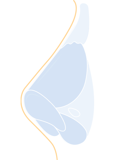 Revision Rhinoplasty