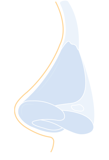 Revision Rhinoplasty