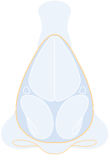Revision Rhinoplasty