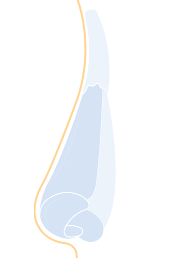 Revision Rhinoplasty