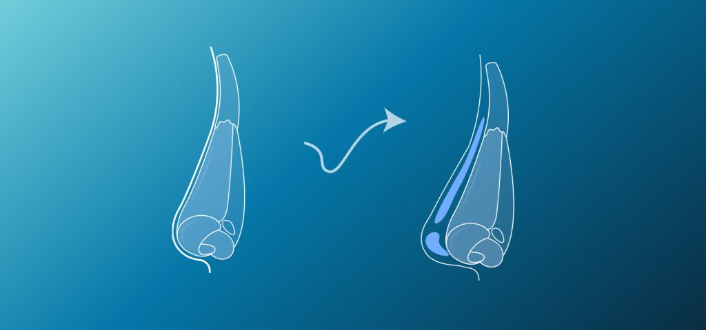 Low Nasal Bridge Surgery