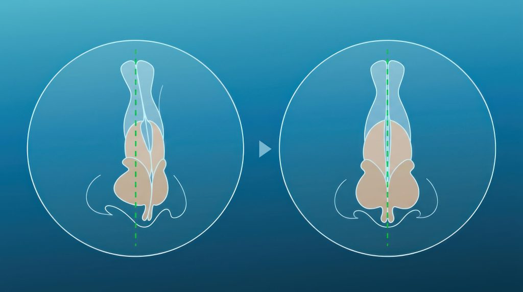 Deviated Nasal Bridge Surgery