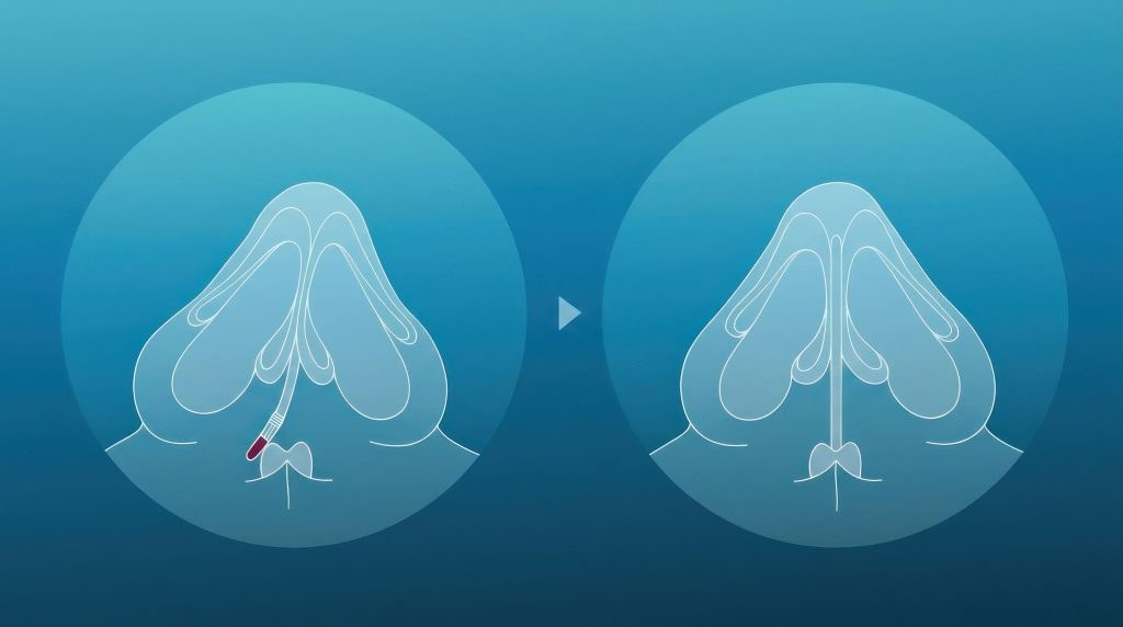 Deviated Nasal Bridge Surgery