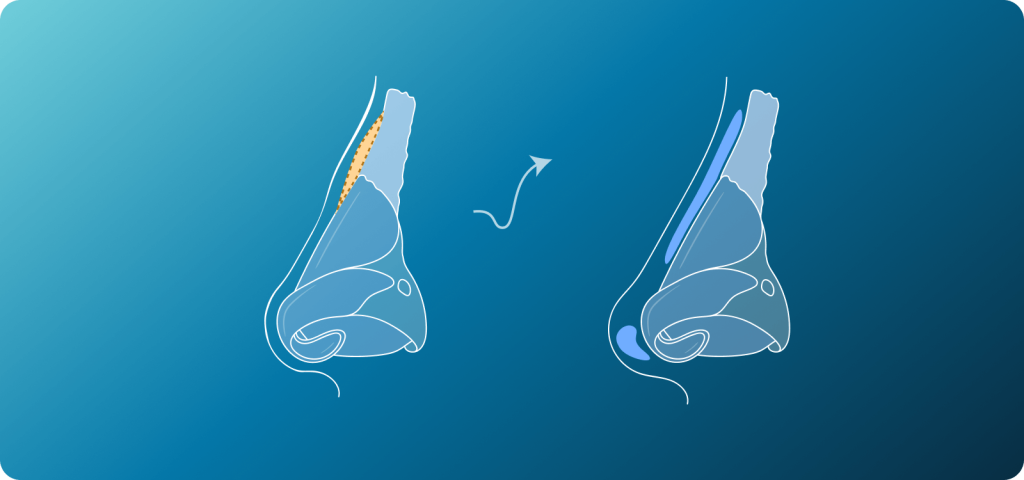 Hooked Nasal Bridge Surgery