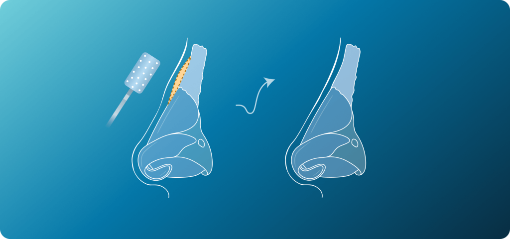 Hooked Nasal Bridge Surgery