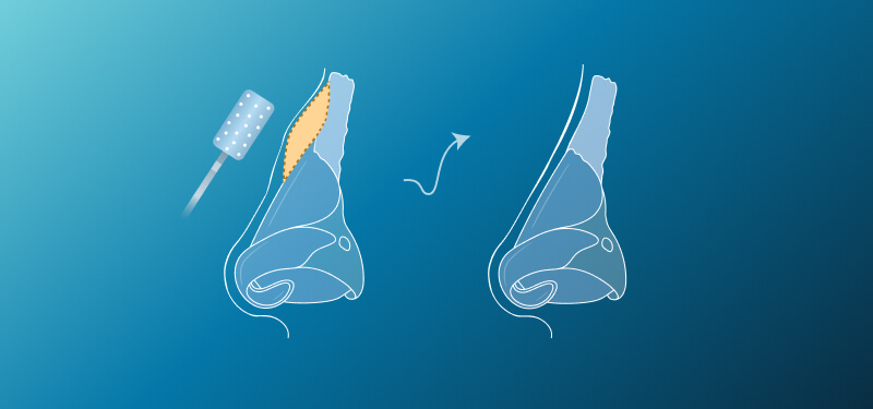 Hooked Nasal Bridge Surgery