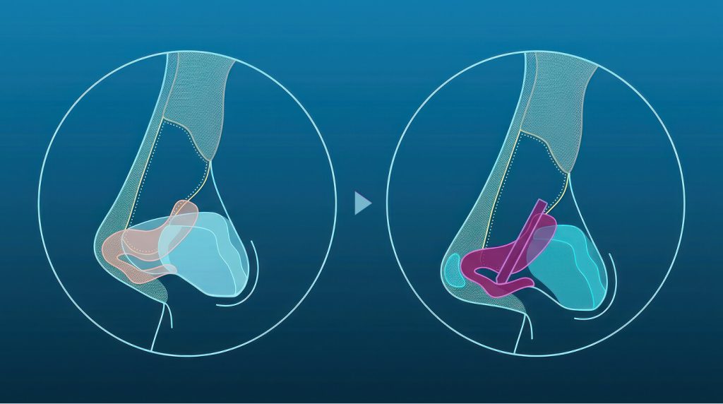 Short Nasal Tip Surgeries (Upturned)