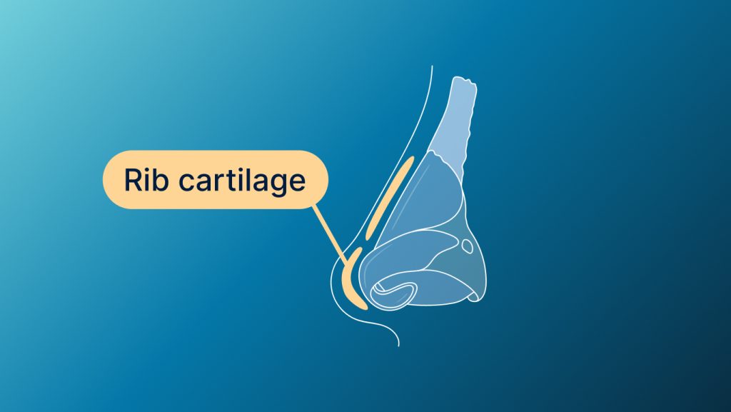 Rib Cartilage Rhinoplasty