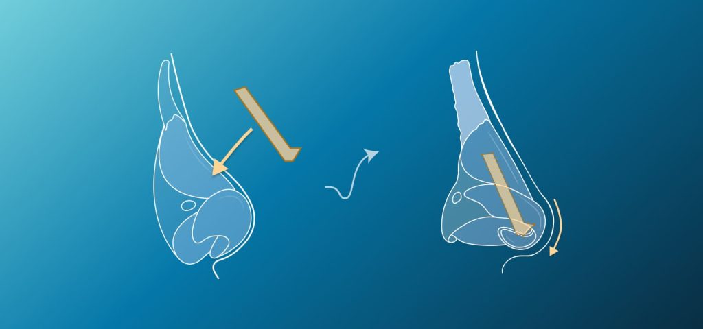 Nasal Contracture Revision